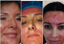 PRP: Vampirski tretman u prevenciji i regeneraciji kože