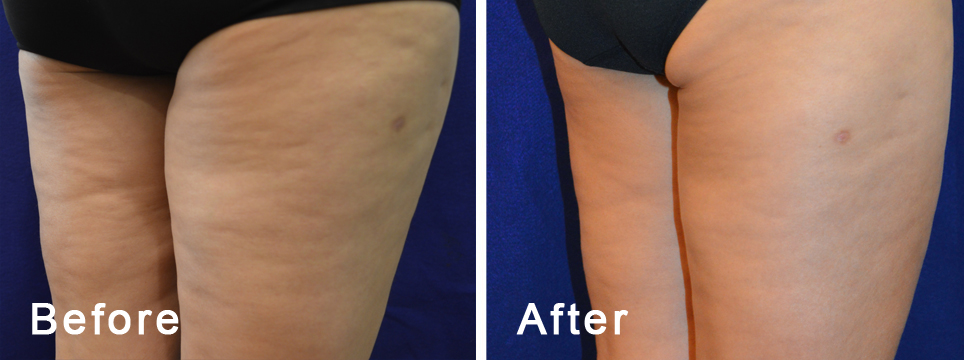 Body FX pre i posle tretmana