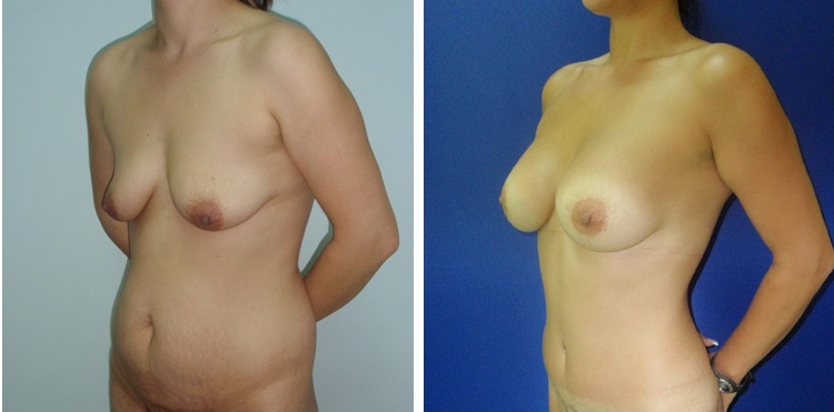 Liposukcija zatezanje stomaka i lifting grudi - bolnica Diona