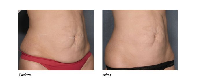 Vela Shape Отзывы Фото До И После