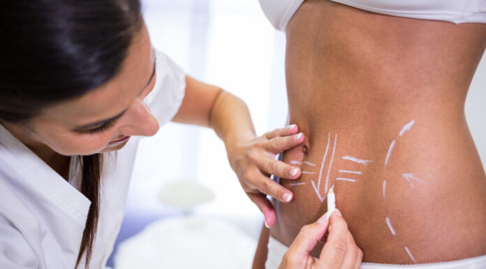 Istina o liposukciji koju vam ne govore: Zašto se masne naslage često vraćaju